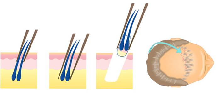 Как выполняют трансплантацию волос, плюсы и минусы пересадки волос